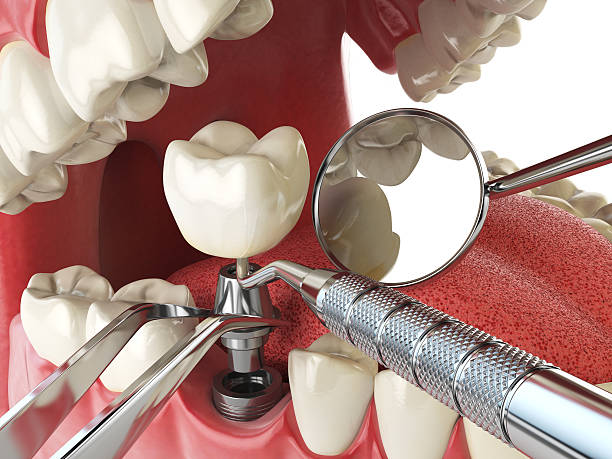 Best Chipped Tooth Repair Near Me  in West Branch, IA